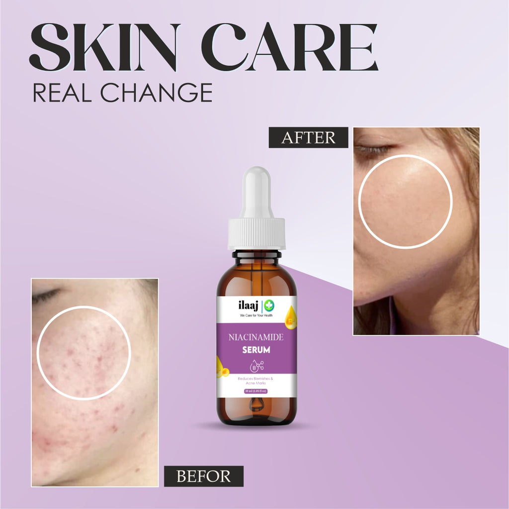 Ilaaj Niacinamide Face Serum, 5% Niacinamide + 2% Alpha Arbutin, For Pigmentation and Acne Marks, 30 ml