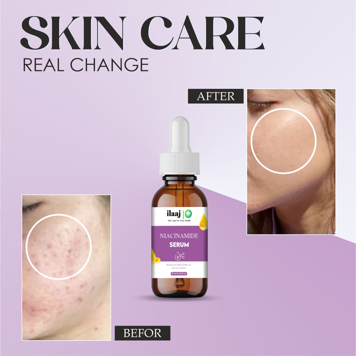 Ilaaj Niacinamide Face Serum, 5% Niacinamide + 2% Alpha Arbutin, For Pigmentation and Acne Marks, 30 ml