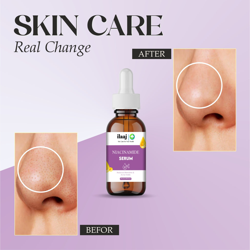 Ilaaj Niacinamide Face Serum, 5% Niacinamide + 2% Alpha Arbutin, For Pigmentation and Acne Marks, 30 ml