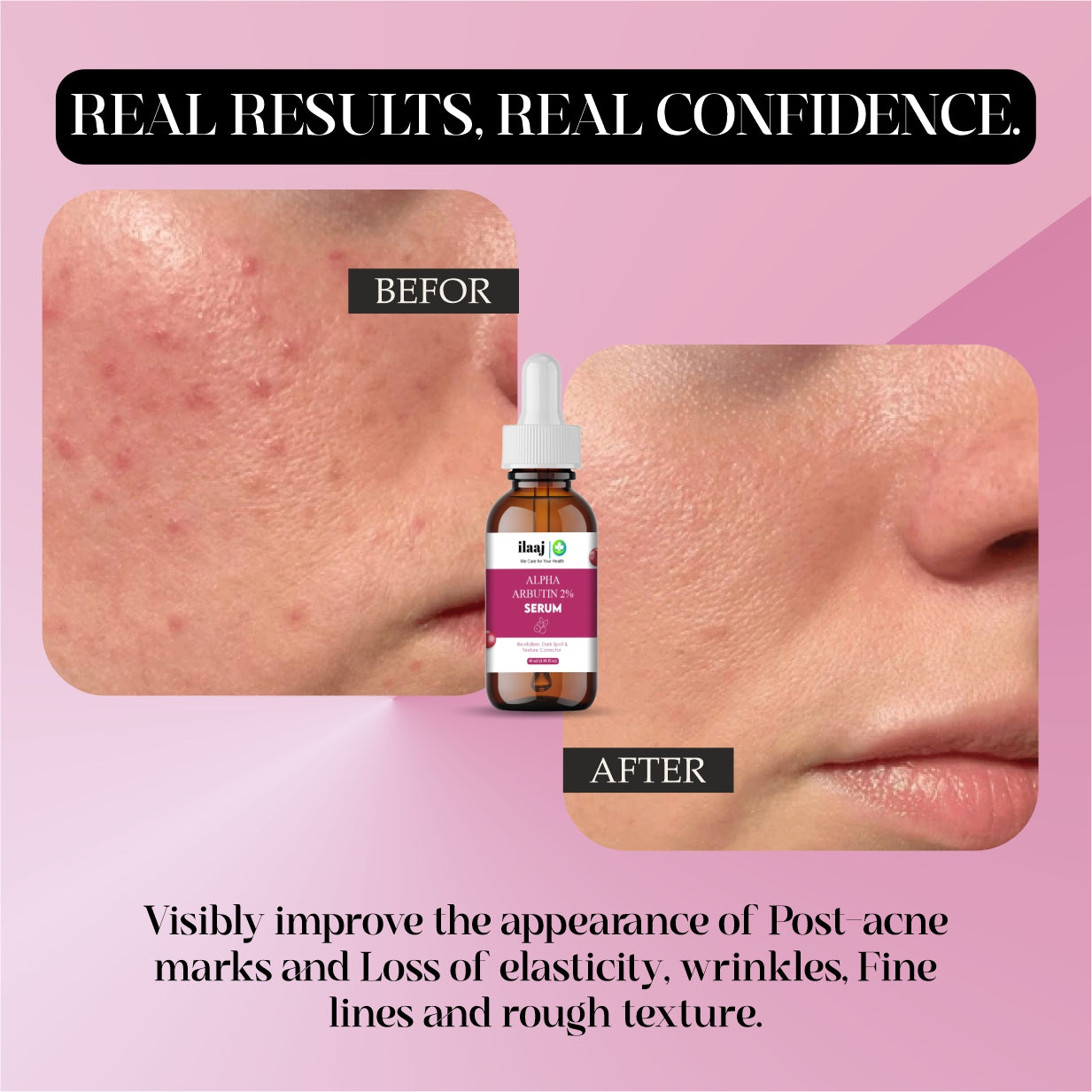 2% Alpha Arbutin & Hyaluronic Acid Face Serum | Fades Tan | Brightens Skin | 2% Alpha Arbutin Face Serum - 30ml | Treats Dark Spots | Evens Skin Tone