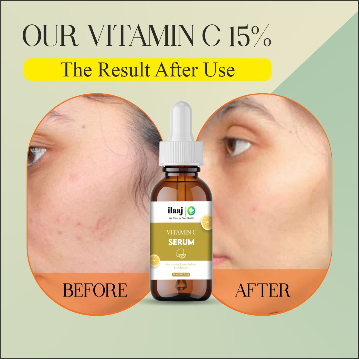 Ilaaj Vitamin C Face Serum, 30ml, For All Skin Types, Brightening and Anti-aging Formula with Ethyl Ascorbic Acid, PHA